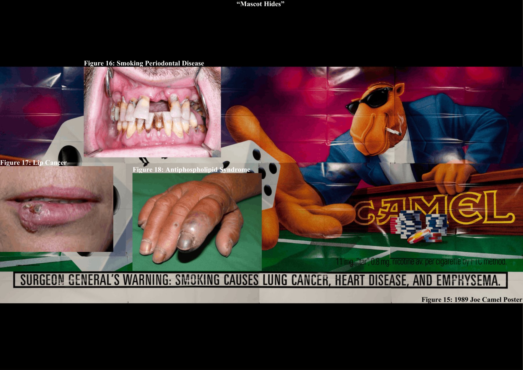 'Mascot Hides' — a Joe Camel billboard layered over clinical images of smoking harms: periodontal disease, lip cancer and antiphospholipid syndrome (Figures 15 to 18).